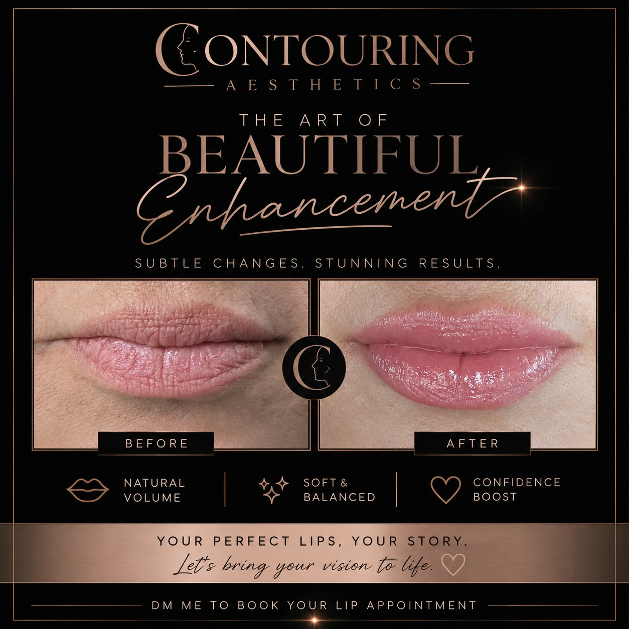 Before and after: Lip Filler, lips