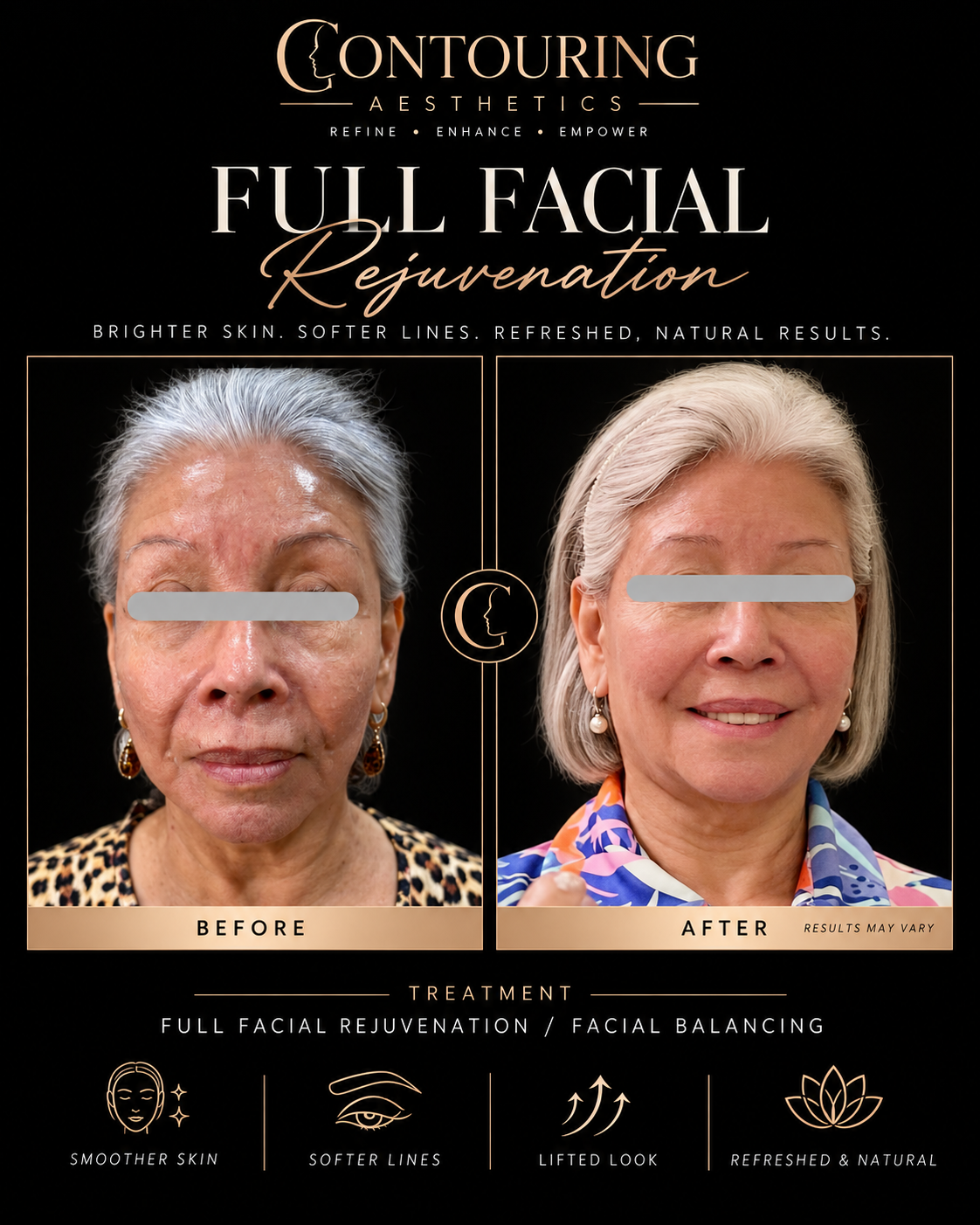Before and after: Full Facial Rejuvenation, full face — a combination of treatments